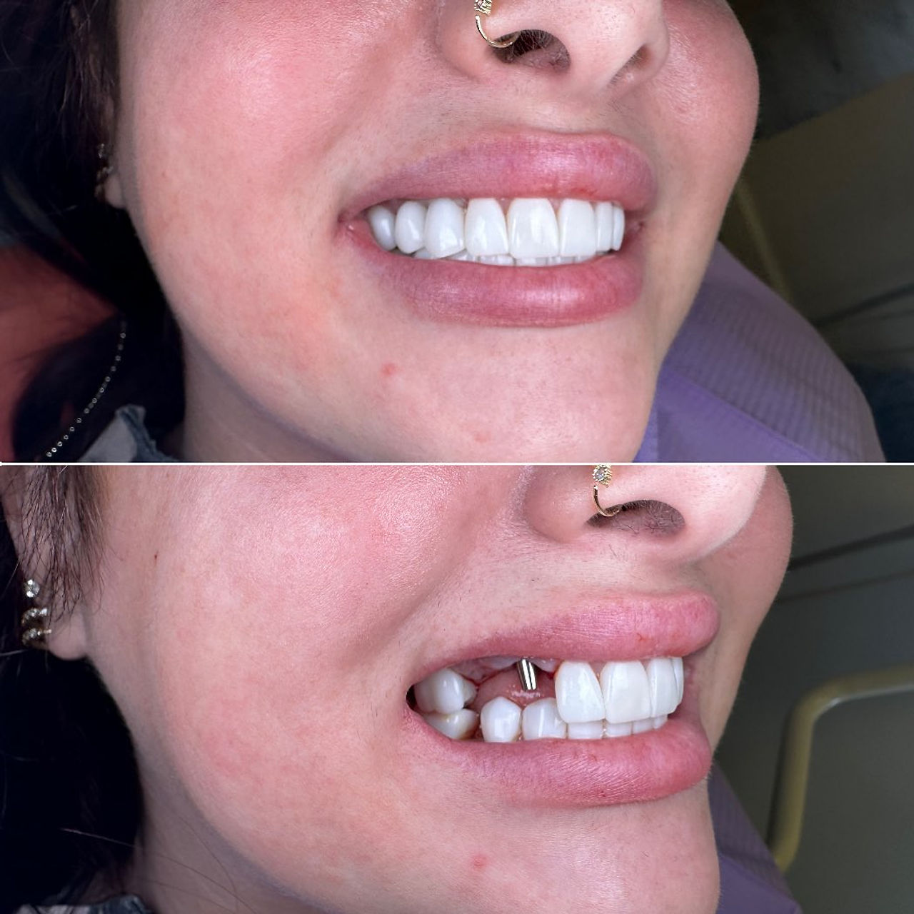 Completing a confident smile before-and-after case