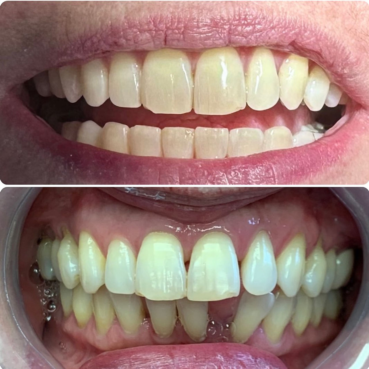 Closing gaps with clear aligners before-and-after case