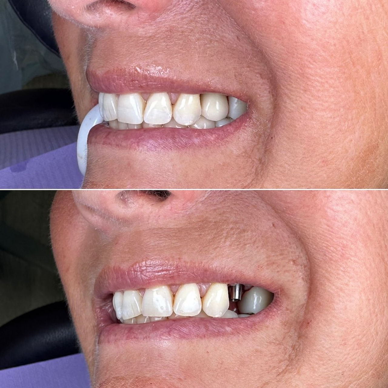 Single-tooth implant restoration before-and-after case