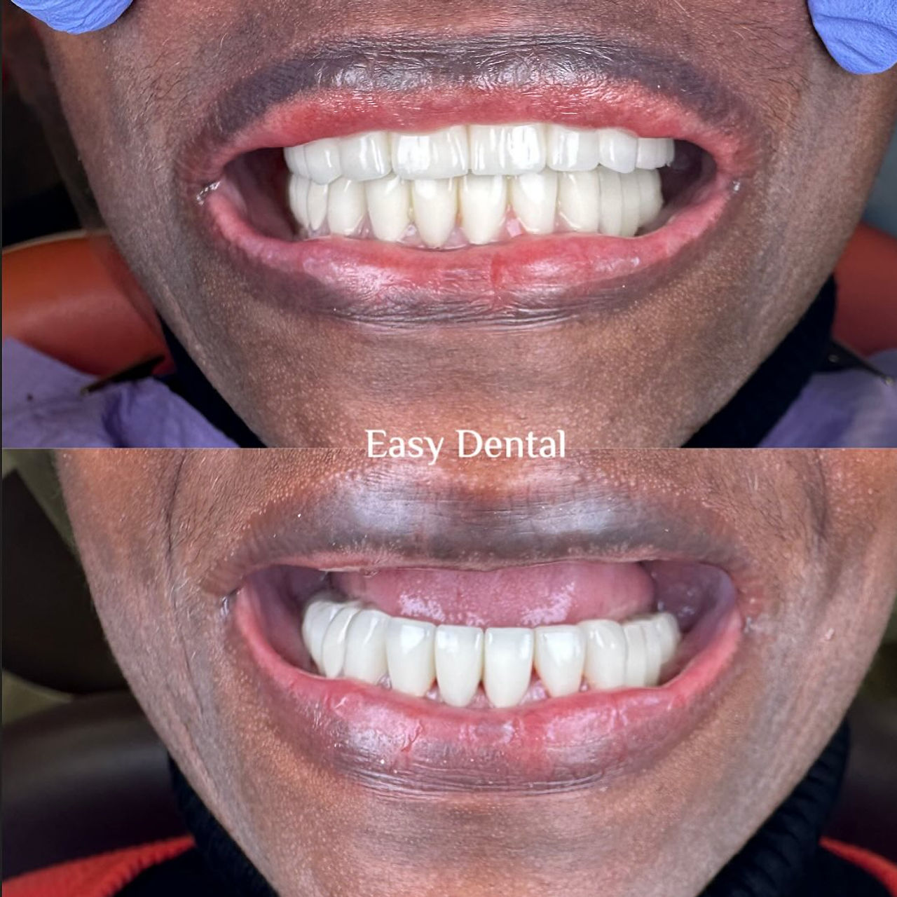 A complete fixed smile before-and-after case