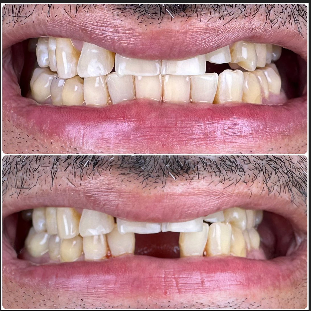 Two teeth restored with one implant before-and-after case