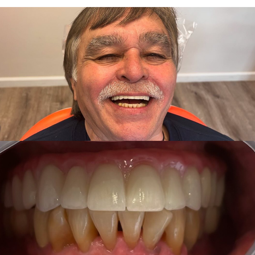Long-term implant confidence before-and-after case