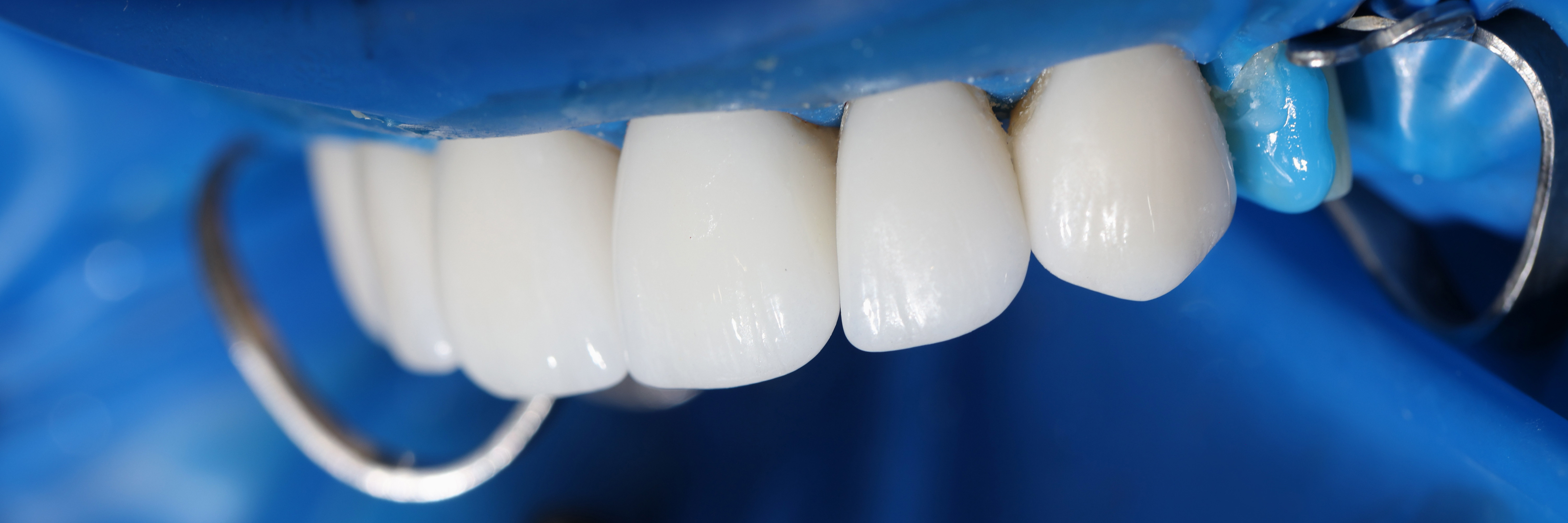 Editorial feature for Are Dental Implants Right for Seniors? What Every West Orange Patient Should Know