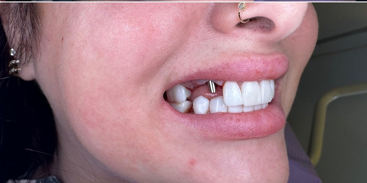 Editorial feature for Is Tooth Erosion Threatening Your Smile? Learn How to Identify and Prevent Acid Damage