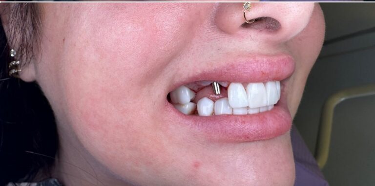 Is Tooth Erosion Threatening Your Smile? Learn How to Identify and Prevent Acid Damage