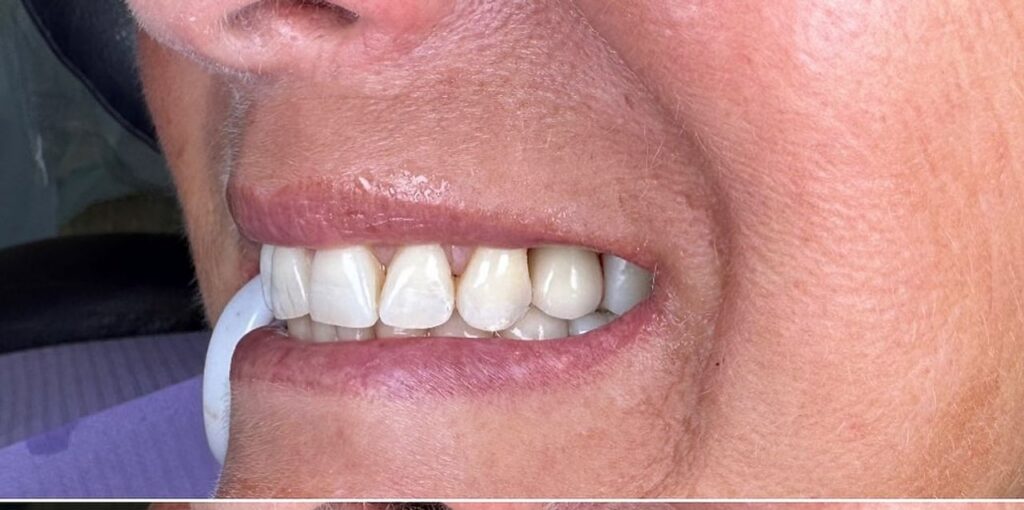 Easy Dental smile result 4