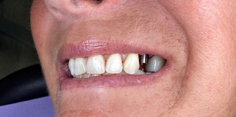 Celebrate Dental Awareness Day with Tips for a Healthier Smile!