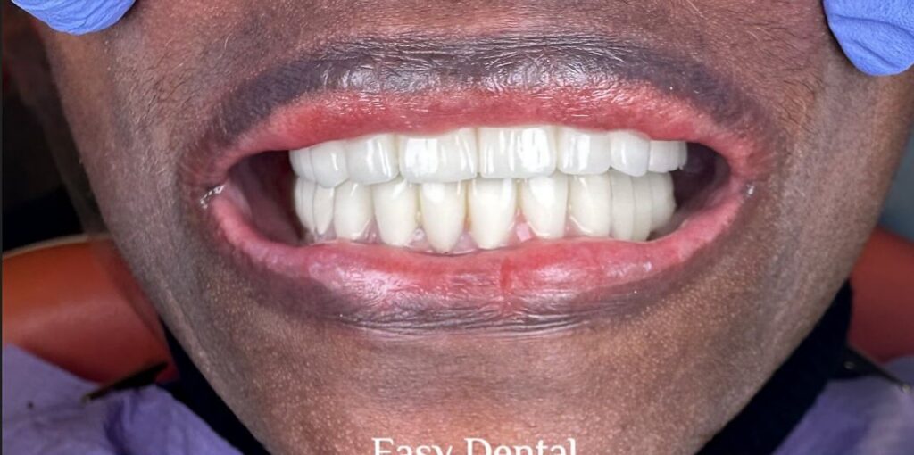 Easy Dental smile result 6