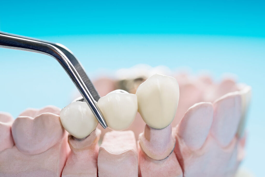 Single Tooth Implant vs Dental Bridge: How to Choose for One Missing Tooth