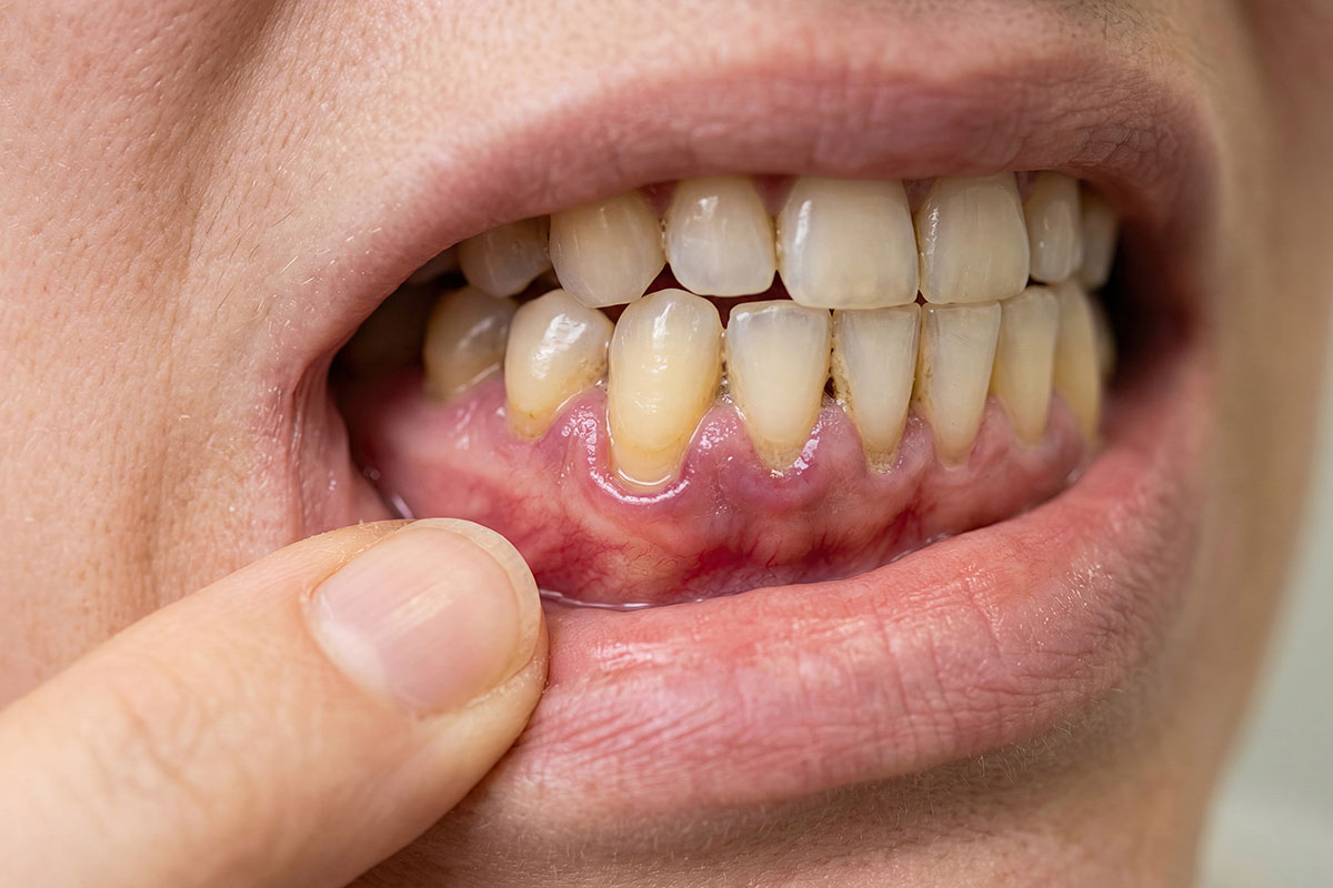 Can You Get Dental Implants With Gum Disease? Why Gum Health Comes First