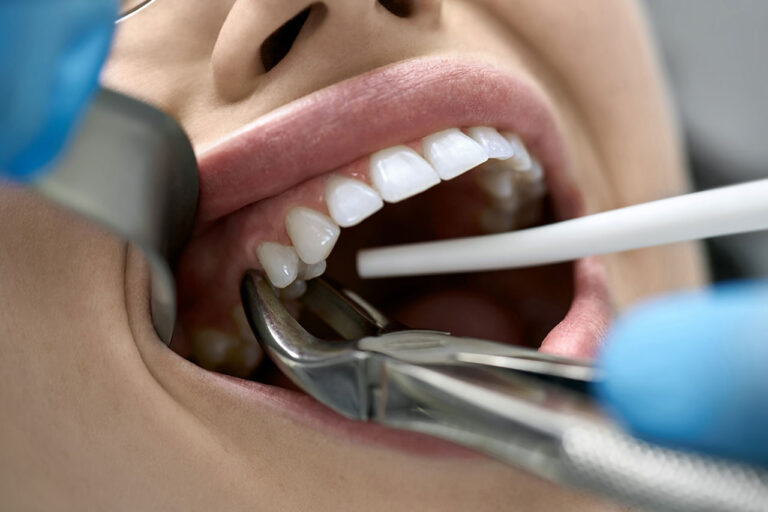 Tooth Extraction Before a Dental Implant: Can the Implant Be Placed the Same Day?